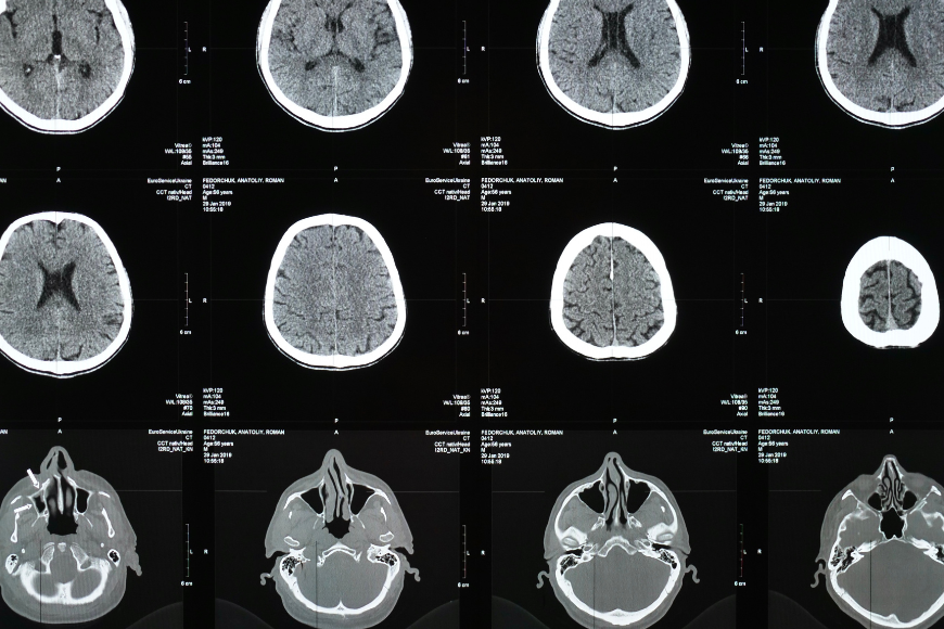 Interventional Radiology