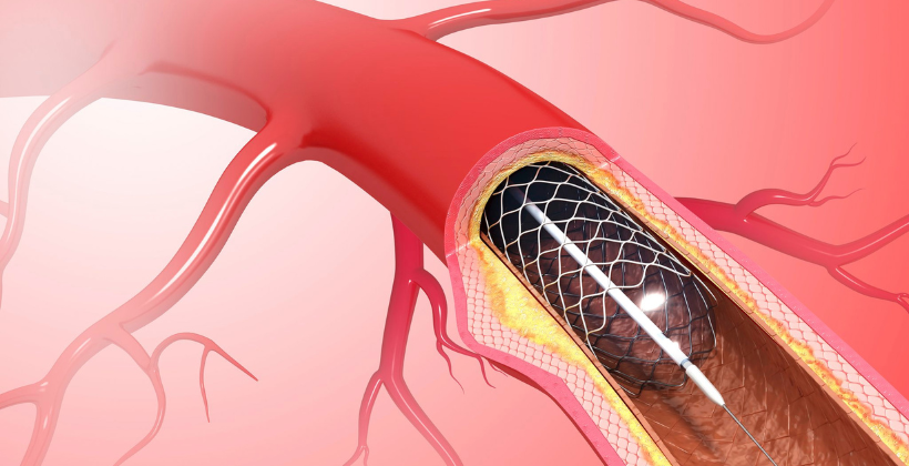 angioplasty and angiography