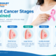 Breast cancer stages 0 to 4 explained with medical illustrations by Zynova Shalby Hospital