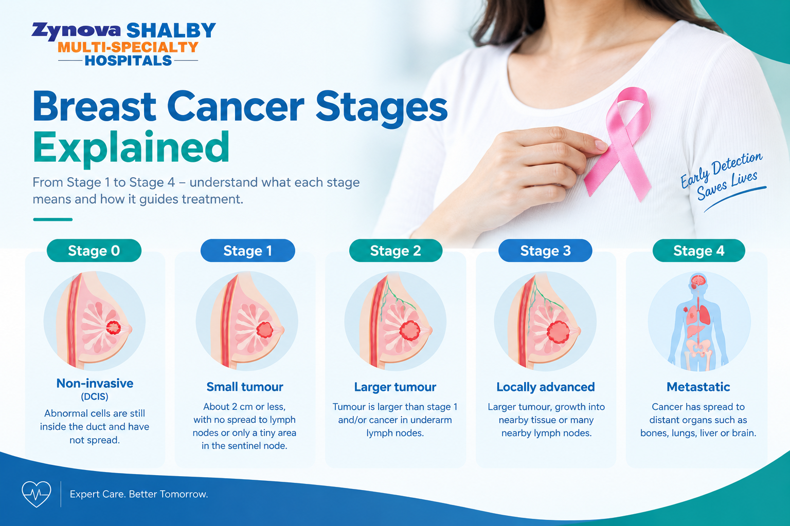 Breast cancer stages 0 to 4 explained with medical illustrations by Zynova Shalby Hospital